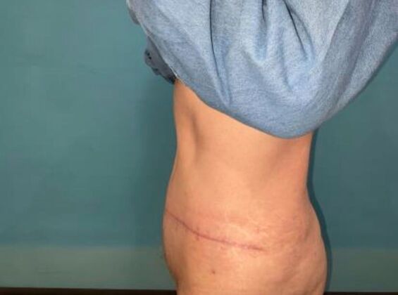 Tummy Tuck: Case 8 - After