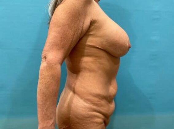 Mommy Makeover: Case 42 - Before