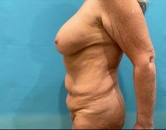 Mommy Makeover: Case 42 - Before