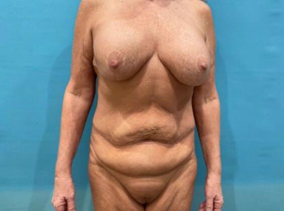 Mommy Makeover Case 42 - Before