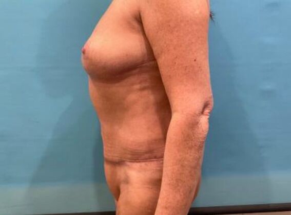 Mommy Makeover: Case 42 - After