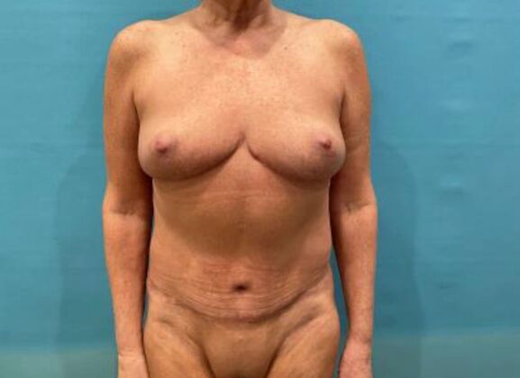 Mommy Makeover Case 42 - After