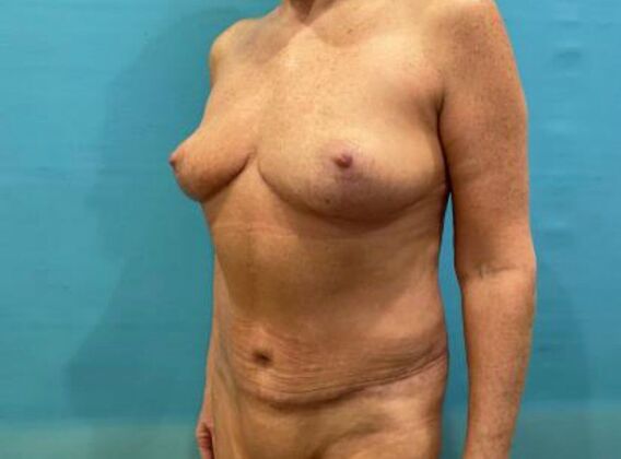 Mommy Makeover: Case 42 - After