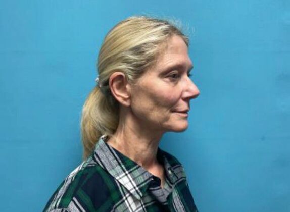 Facelift: Case 21 - Before