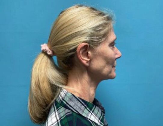 Facelift: Case 21 - Before