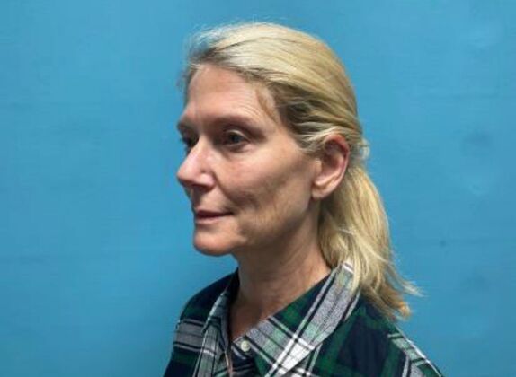 Facelift: Case 21 - Before