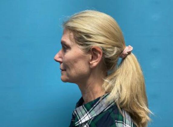 Facelift: Case 21 - Before