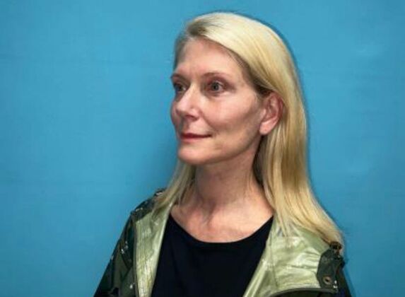 Facelift: Case 21 - After