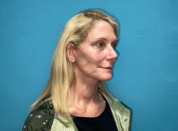 Facelift: Case 21 - After