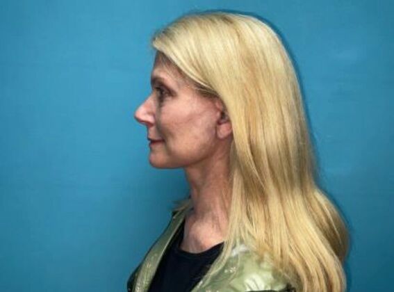 Facelift: Case 21 - After