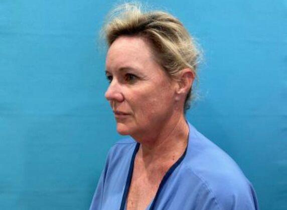 Facelift: Case 22 - Before