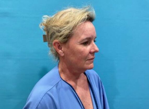 Facelift: Case 22 - Before