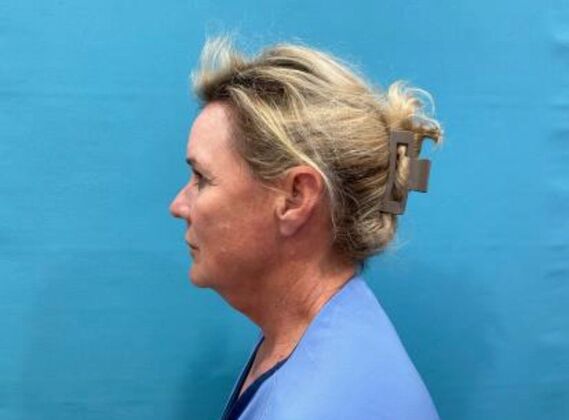 Facelift: Case 22 - Before