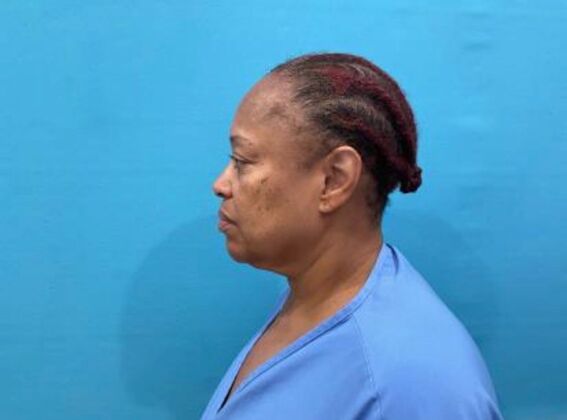 Facelift: Case 23 - Before