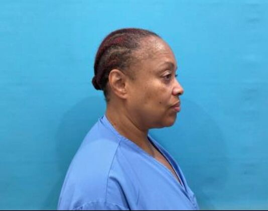 Facelift: Case 23 - Before