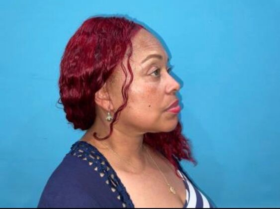 Facelift: Case 23 - After