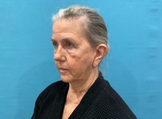 Facelift: Case 24 - Before