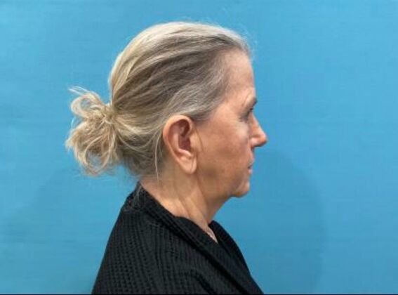 Facelift: Case 24 - Before