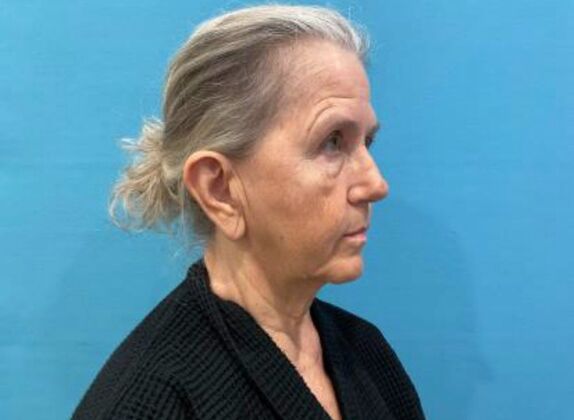 Facelift: Case 24 - Before