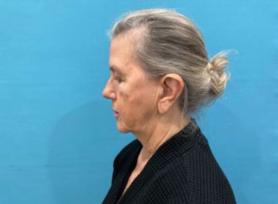 Facelift: Case 24 - Before