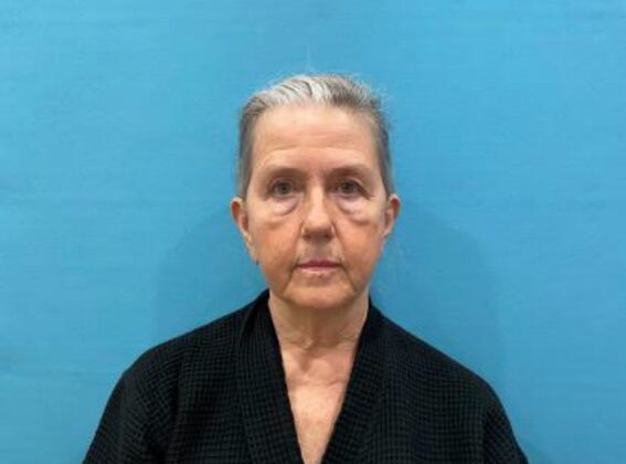 Facelift Case 24 - Before