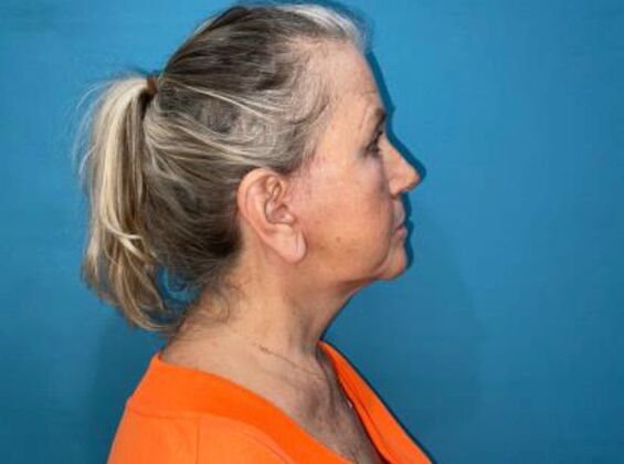 Facelift: Case 24 - After