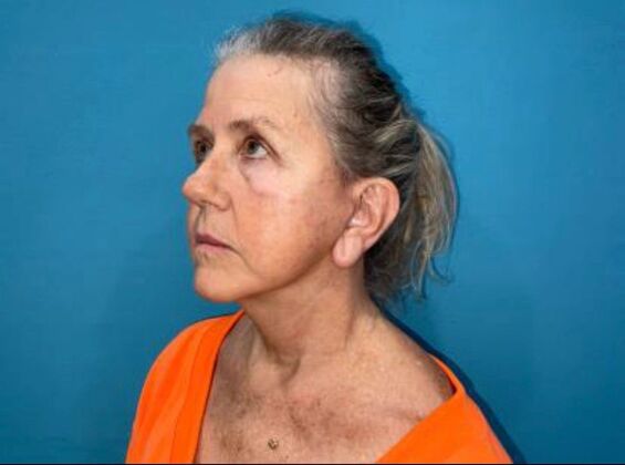 Facelift: Case 24 - After