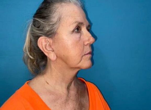 Facelift: Case 24 - After