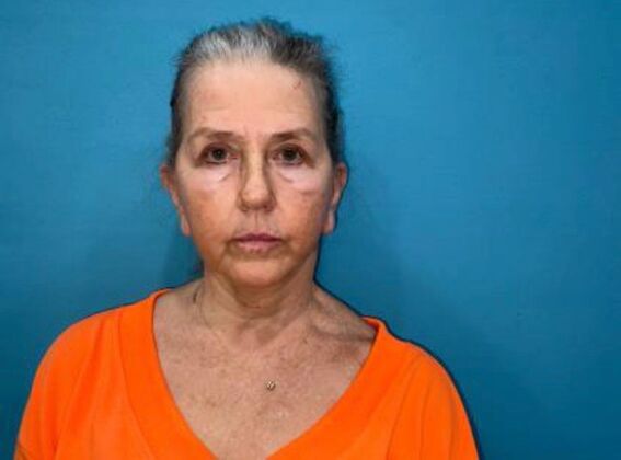 Facelift Case 24 - After