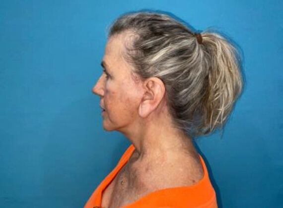 Facelift: Case 24 - After