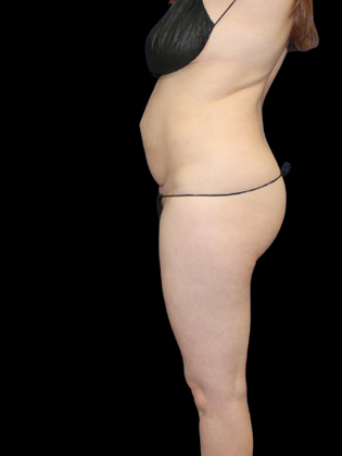 Tummy Tuck Tummy Tuck 3 - Before
