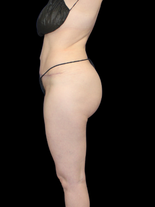 Tummy Tuck Tummy Tuck 3 - After