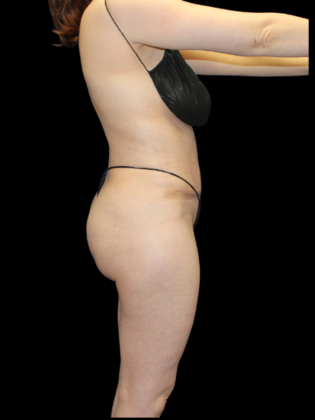 Liposuction Case 13 - After