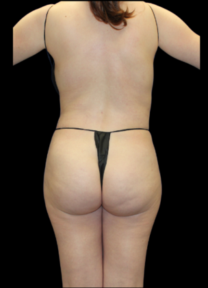 Liposuction: Case 13 - After