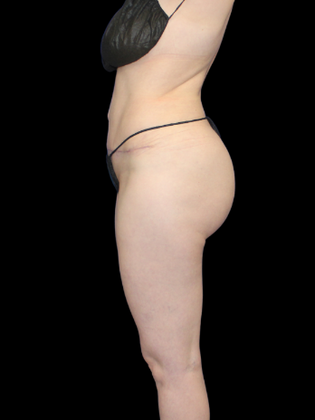 Liposuction: Liposuction  14 - After