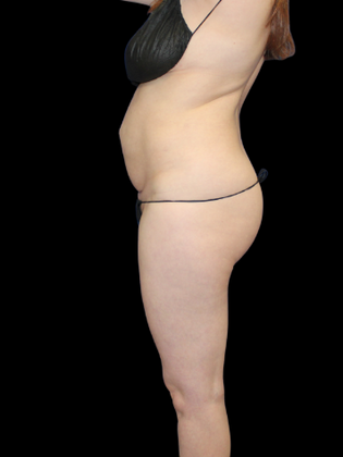 Liposuction: Liposuction  14 - Before