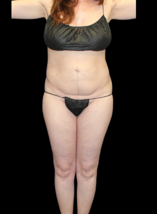 Liposuction: Case 13 - Before