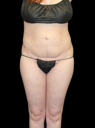 Liposuction Liposuction  14 - Before