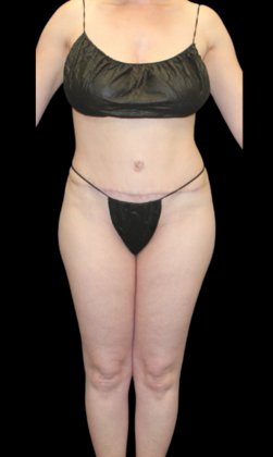 Liposuction: Case 13 - After