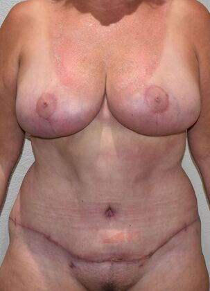 Mommy Makeover Case 372 - After