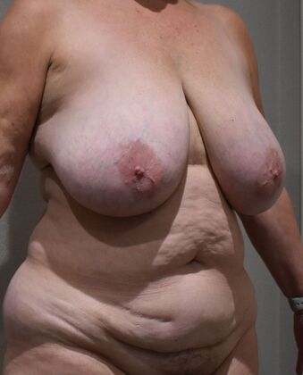 Massive Weight Loss : Case 209 - Before