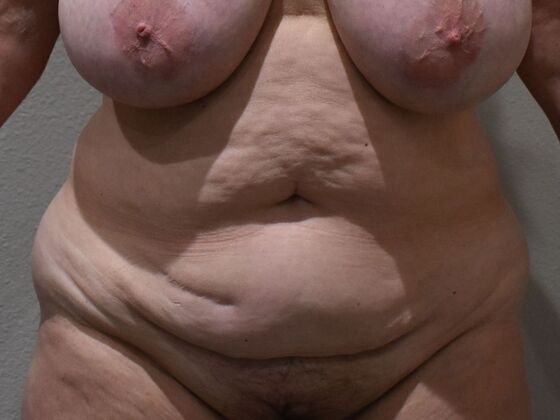 Tummy Tuck (Abdominoplasty): Case 584 - Before