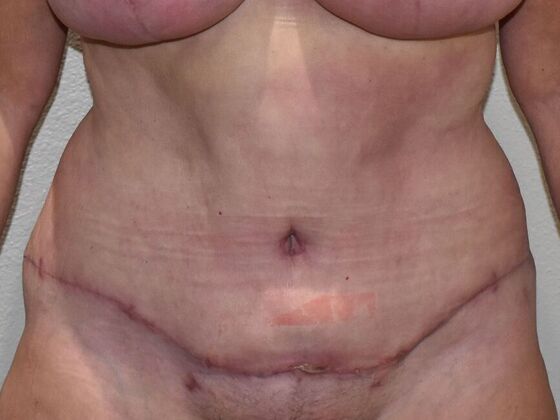 Tummy Tuck (Abdominoplasty): Case 584 - After