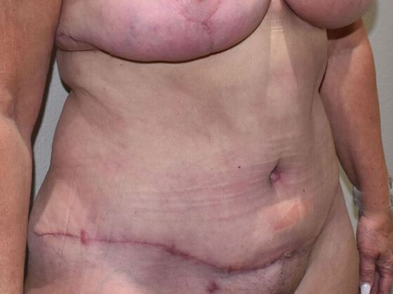 Tummy Tuck (Abdominoplasty): Case 584 - After