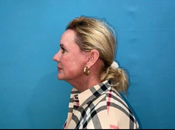 Facelift: Case 22 - After