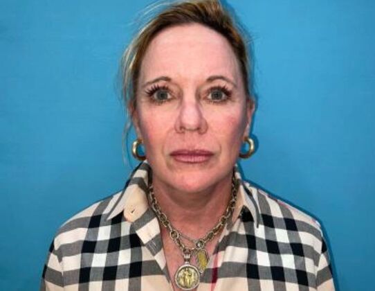 Facelift Case 22 - After