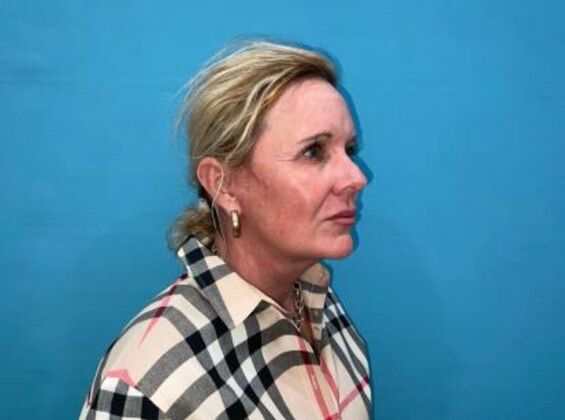 Facelift: Case 22 - After