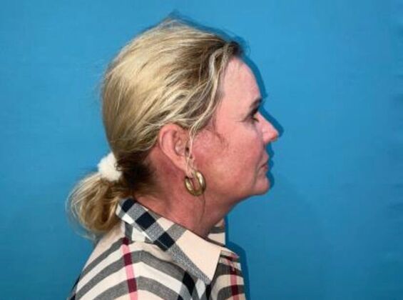 Facelift: Case 22 - After