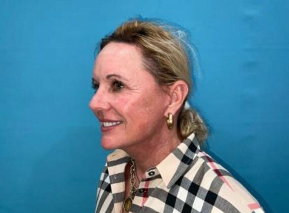 Facelift: Case 22 - After