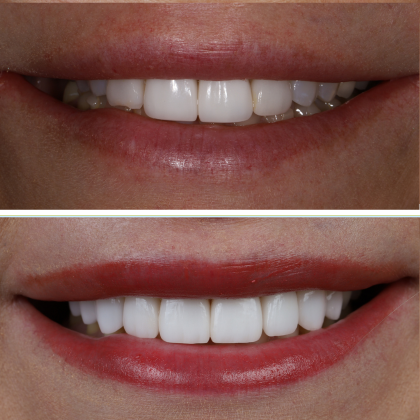No Prep Porcelain Veneers Tracey - Before